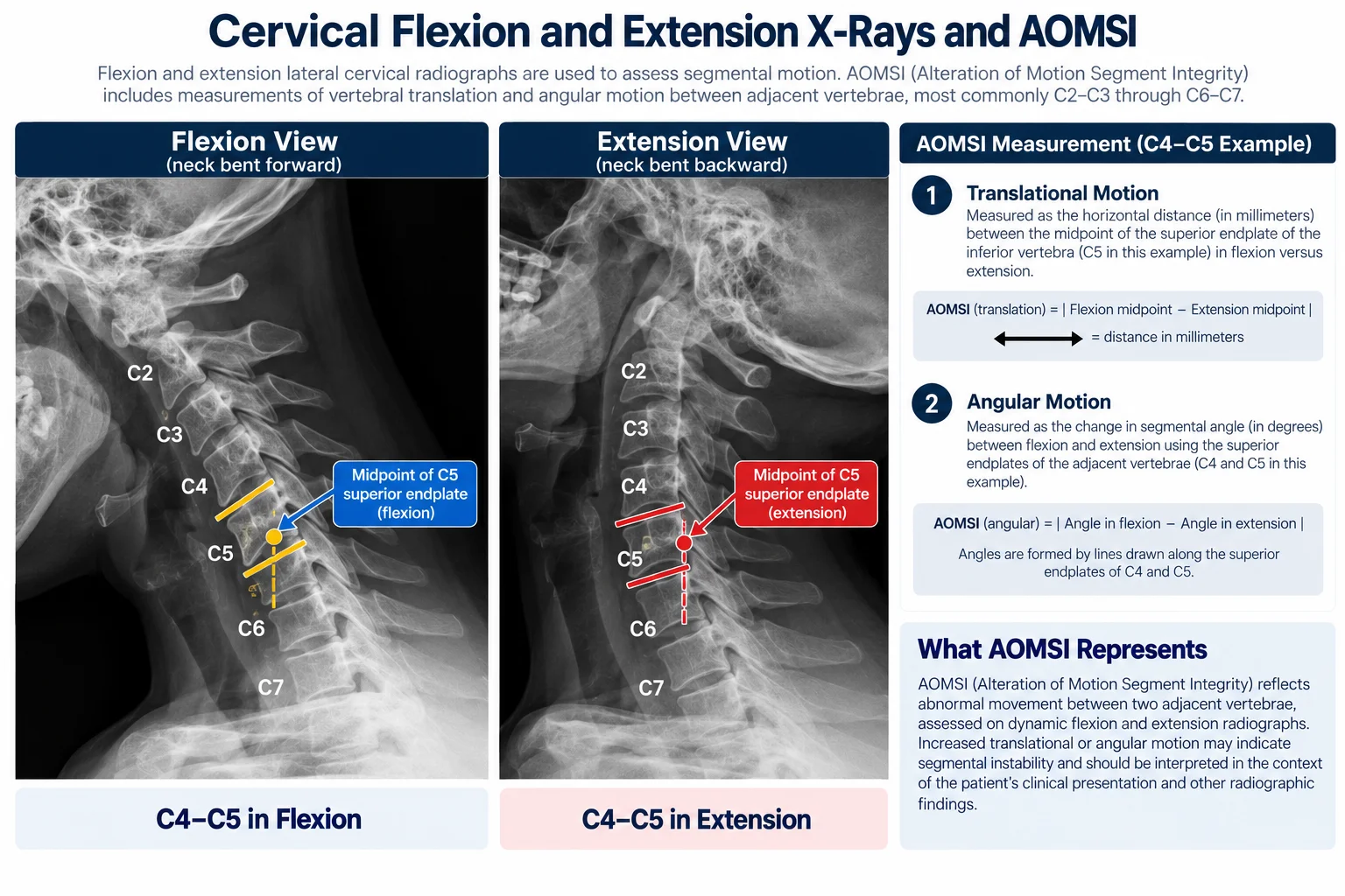 Cervical flexion and extension X-ray comparison showing AOMSI measurements at C4-C5, illustrating translational and angular motion assessment for spinal instability evaluation